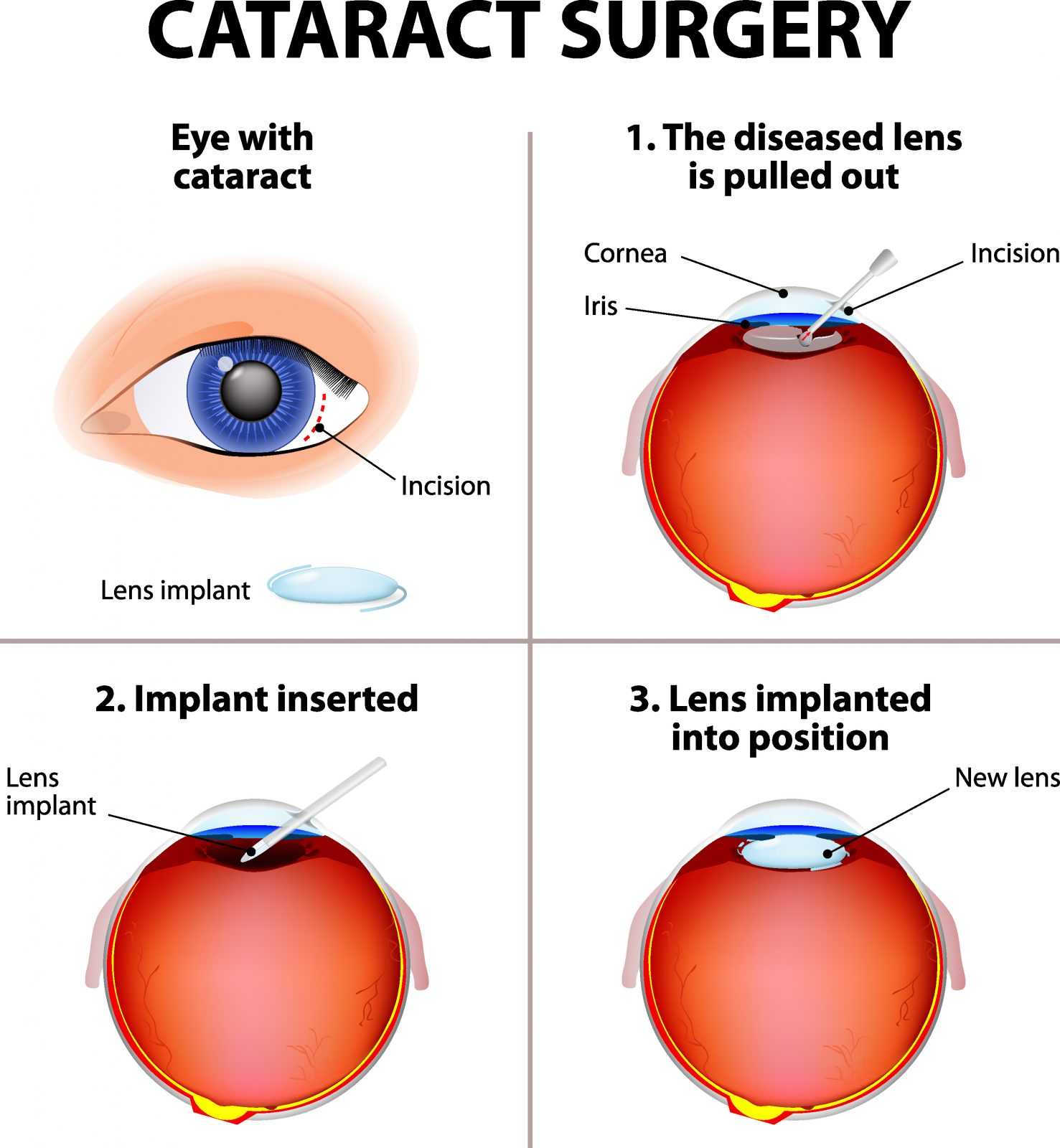 Cataract Treatment