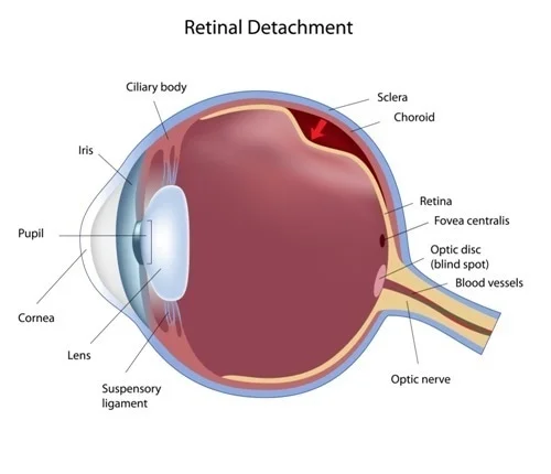 Cataract Treatment