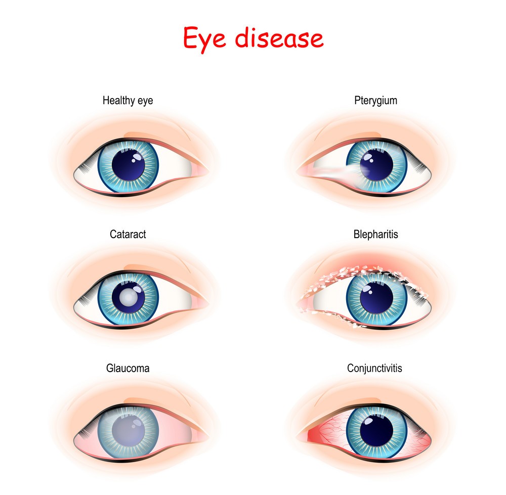 Cataract Treatment