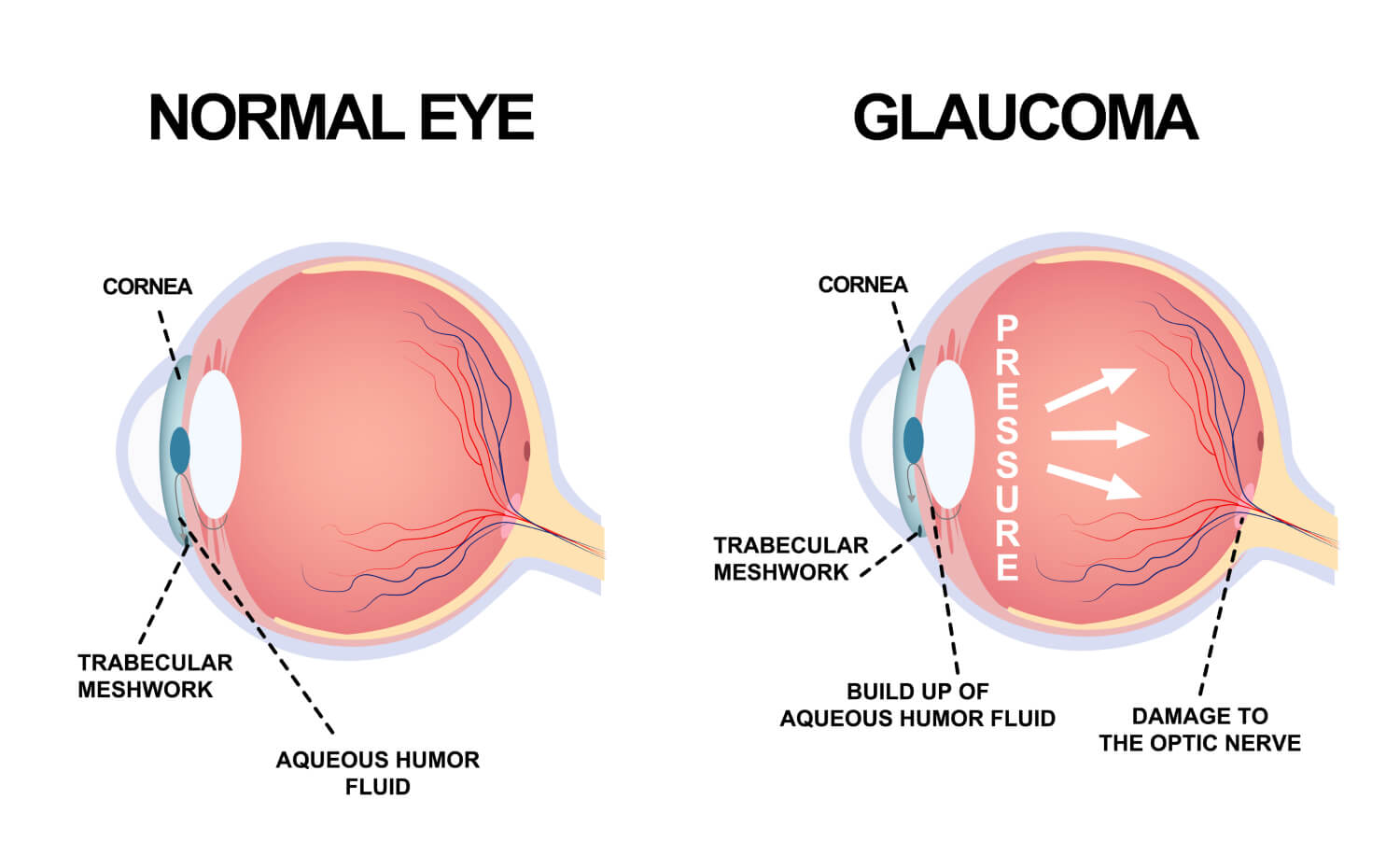 Glaucoma Management